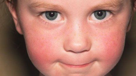 Scarlatină în mai multe școli din Drobeta Turnu Severin