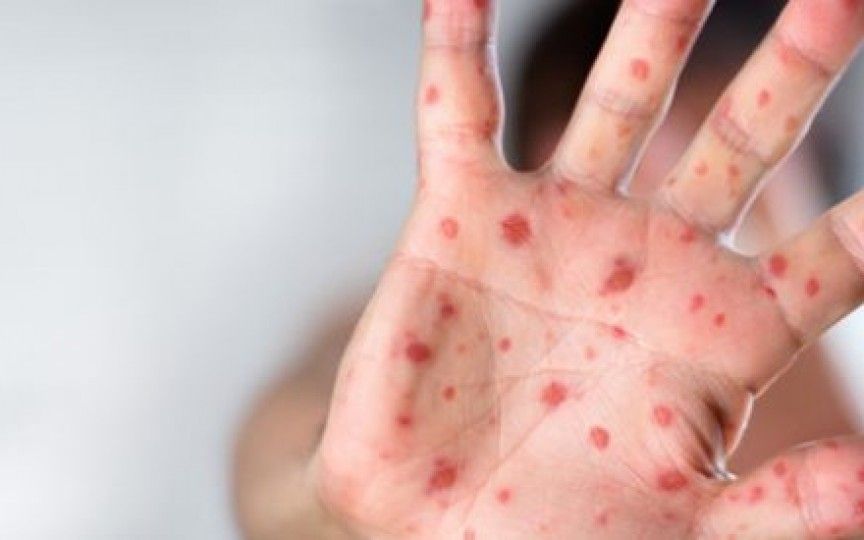 Rujeola a lovit puternic și în Mehedinți